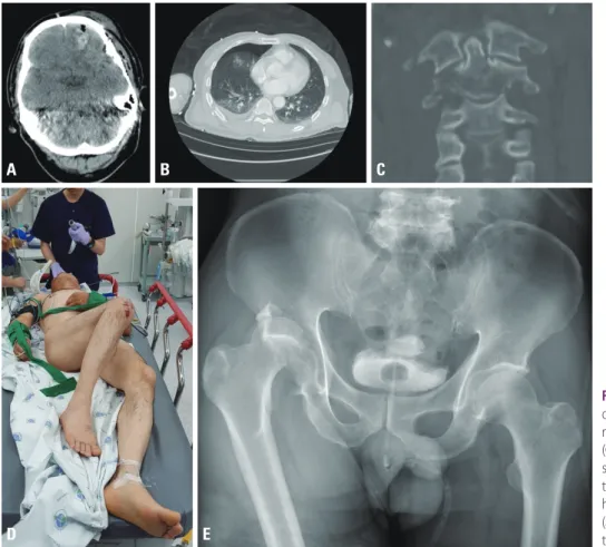 Fig. 1. The patient had multiple organ  damages. (A) Intracerebral  hemor-rhage. (B) Right hemo-pneumothorax