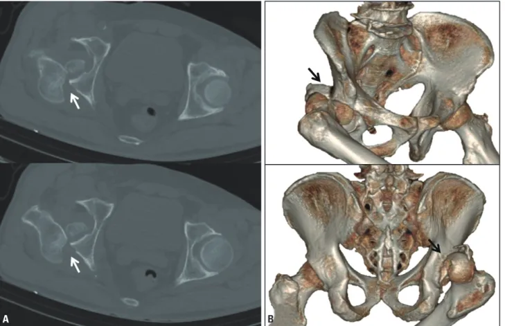Fig. 3. (A) An initial X-ray of the pelvis (anterior posterior view) and 3D reconstruction image of the right femur