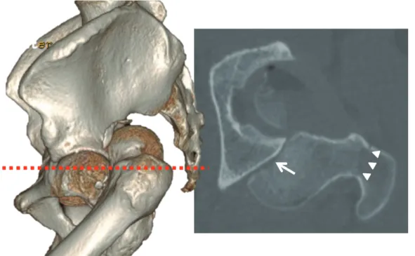Fig. 6. Pre-operative axial CT scans of the pelvis showing fracture-dislocation of the left hip joint