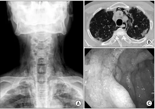 Figure 4. (A) Neck AP shows mediastinal and subcutaneous emphysema. (B)  HRCT shows the mediastinal emphysema with  multiple  patchy  densities  on  both  upper  lobes