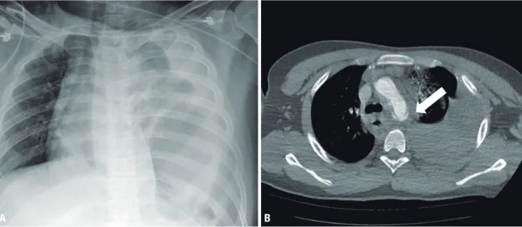 Fig. 1. Initial chest X-ray and chest CT. Chest X-ray show stomach herniation and large amount of hemothorax (A)