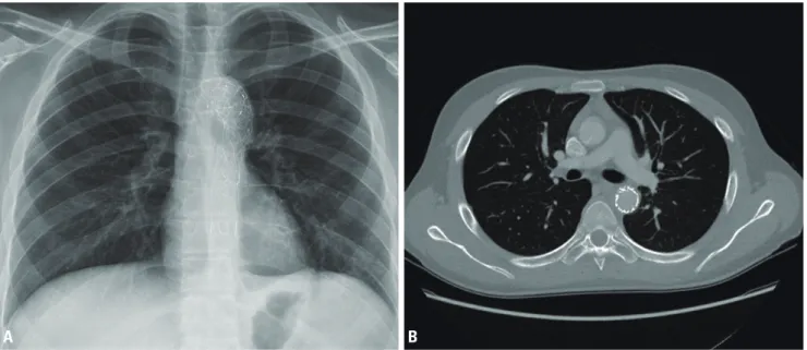 Fig. 4. (A, B) Following chest X-ray and chest CT before hospital discharge. Endovascular stent graft in descending aorta was well functioned and no  evidence of endoleak