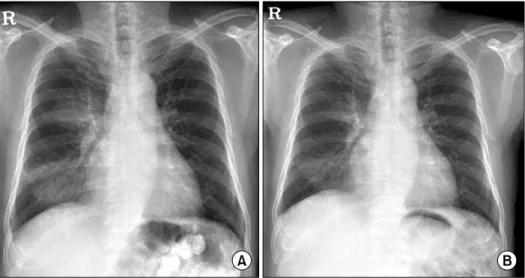 Figure  2.  (A,  B)  Initial  chest  HRCT  scans  shows  a  mass-like  opacity  in  the  superior  and  posterobasal  segment  of  the right  lower  lobe