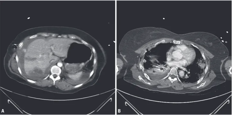 Fig. 1. Abdominal and thoracic CT scan of the patient on primary work up after motor vehicle injury