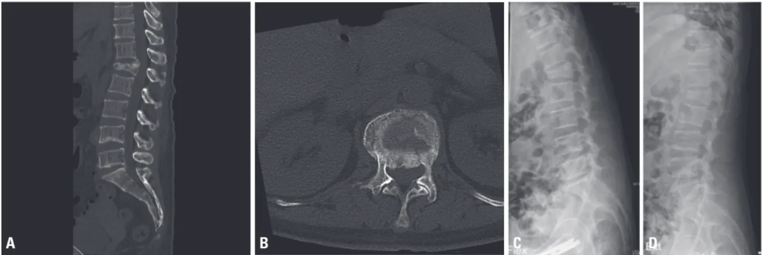 Fig. 3. Thoracolumbar spinal magnetic resonance image of the same patient 2 weeks after injury