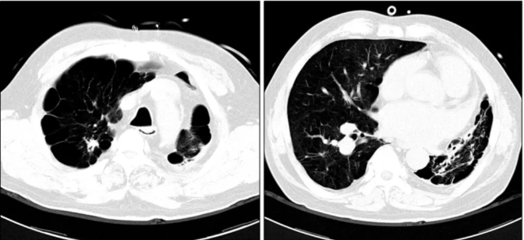 Figure 2. Lung setting of chest CT shows decreased lung volume, bullous  emphysema, traction bronchiectasis, architec- architec-tural  distortion  and  multiple  small  calcifications  in  right  upper  lobe,  superior  segment  of  right  lower  lobe  and