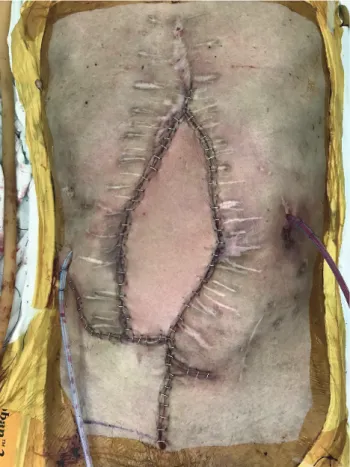 Fig. 3. Immediate postoperative view of the patient’s abdomen com- com-pletely covered with the LD myocutaneous free flap and local 