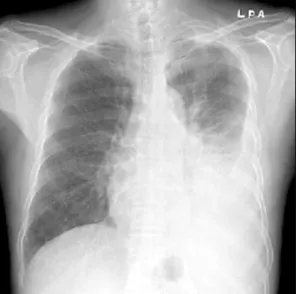 Figure  2.  Chest  CT  scan  reveals  pleural  nodularity  and an  irregular-shaped  subpleural  mass  in  the  left  upper  lobe.
