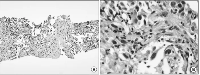 Figure 4. Histopathologic findings reveal poorly differentiated adenocarcinoma (A: H&amp;E stain, ×100, B: H&amp;E stain, ×400).