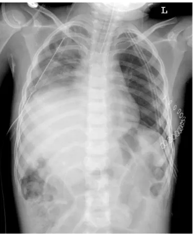 Fig. 1. Preoperative (1st operation) chest X-ray shows elevated stomach  into left thorax due to left-sided diaphragmatic rupture and bilateral  pleural effusion.