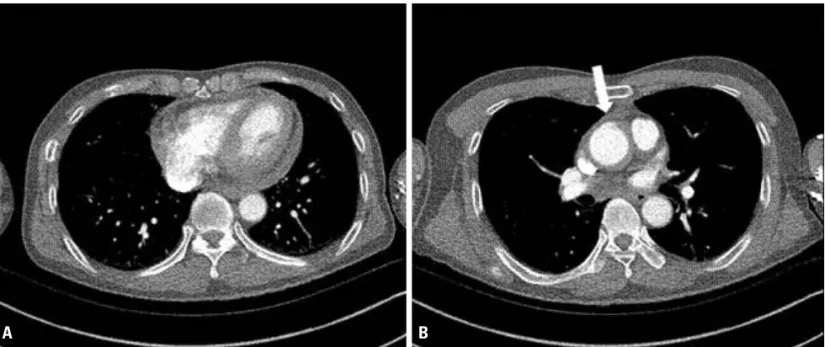 Fig. 2. Follow-up chest CT showing an ascending aortic pseudoaneurysm (arrow) (A), enlarged view (B)