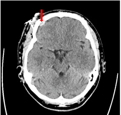 Fig. 2. Computed tomography of thorax, pseudoaneurysm of ascending aorta (arrow) .