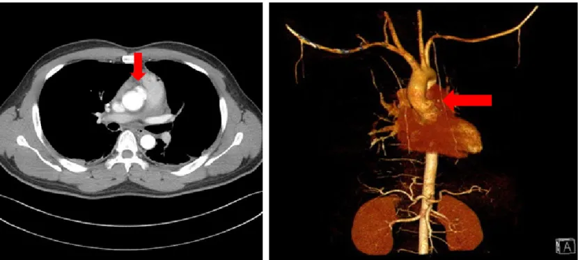 Fig. 3. Computed tomography of thoracic aortography after 1 day. Pseudoaneurysm of ascending aorta (arrow) .