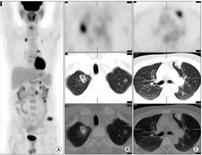 Figure  2.  Coronal  PET  maximum  intensity  projection  image  (A)  shows  multiple  increased  FDG  uptake  at  whole  body