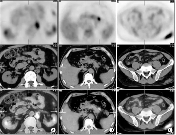 Figure  3.  Transverse  PET  image  (upper  row),  transverse  CT  image  (middle  row)  and  transverse  PET/CT  image  (lower row)  show  left  paraaortic  lymph  node  (A),  peripancreatic  lymphode  enlargement  (B)  with  increased  FDG  uptake  (SUV: