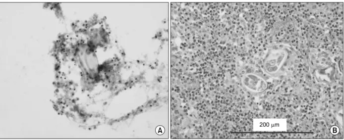 Figure 4. Expectorated sputum after bronchoscopy shows yellowish refractile eggs (H&amp;E stain, ×100) (A), Excised lung shows  distorted  golden  brown  eggs  (about  65×40μm)  in  eosinophil-rich  exudates  (H&amp;E  stain,  ×400)  (B).