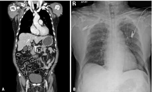 Fig. 1. Chest computed tomogra- tomogra-phy and X-ray shows clavicle  frac-ture (A) with multiple rib fracfrac-ture 