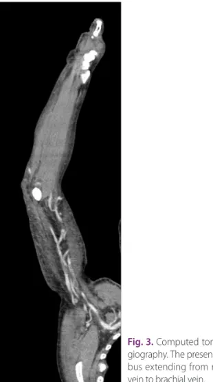 Fig. 3. Computed tomography an- an-giography. The presence of a  throm-bus extending from right cephalic  vein to brachial vein.