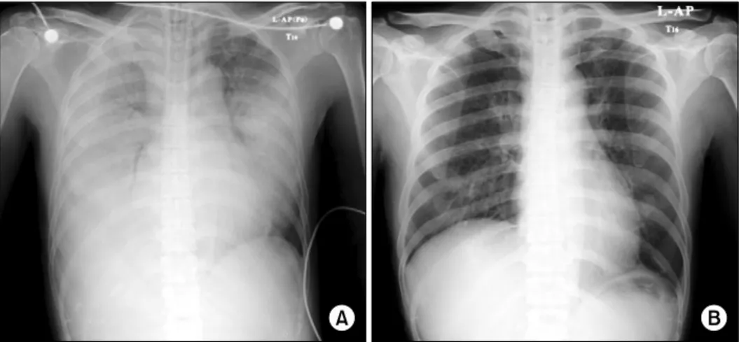 Figure  1.  Chest  PA  at  (A)  admission  and  (B)  discharge.