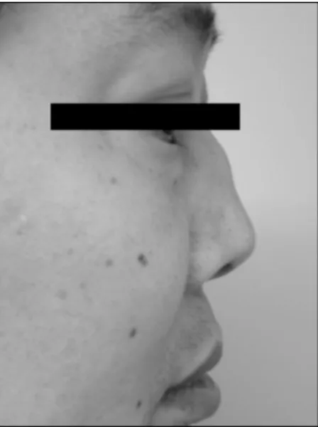 Figure 2. Chest radiography shows cavitary lung mass at the  right  upper  lung  field.