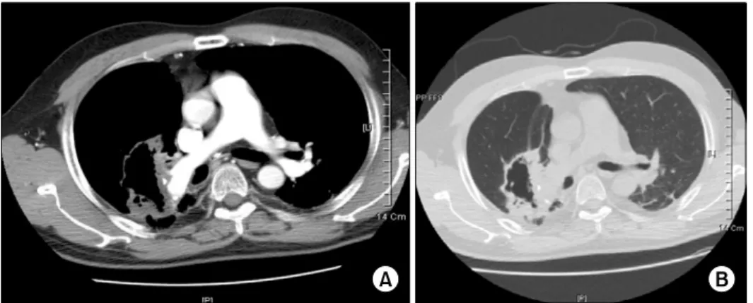 Figure  4.  Facial  CT  shows  small  fluid  density  and  thickening  of  bony  wall  in  the  right  and  left  maxillary  sinuses