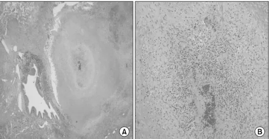 Figure 6. On microscopic examination, the granulomatous necrotizing vasculitis of large arteries and veins (A; H&amp;E stain,