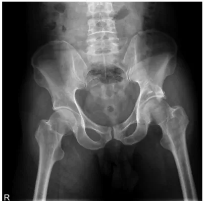 Fig. 1. Initial both hip antero-posterior view of 54 years old male patient  rolling several times after falling down from 2 meter height.