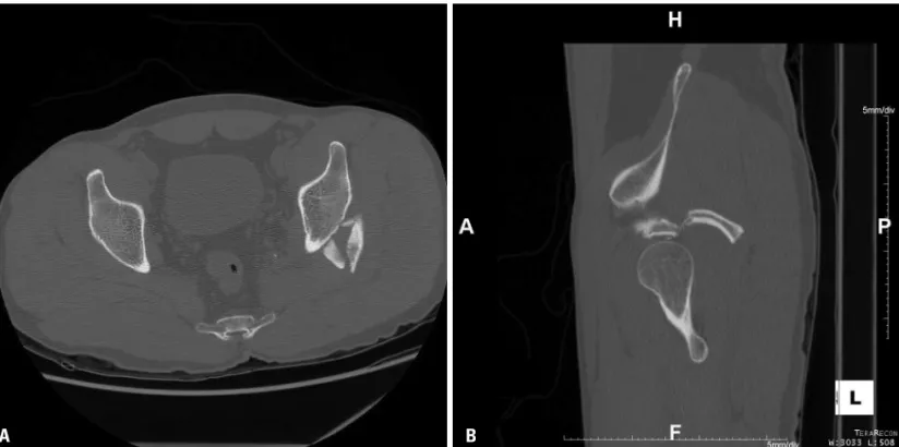 Fig. 4. 3 dimension-computed tomography scan with axial (A) and sagittal (B) views show fracture at the postero-superior aspect of left acetabulum.