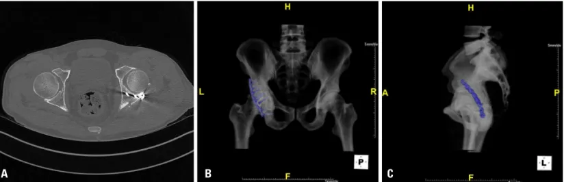 Fig. 6. 3 dimension computed tomography scan on 7 days after operation with axial (A), and bone and metal maximum intensity projection recon- recon-struction image (B &amp; C) show a well maintained fixation.