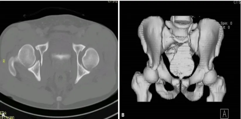 Fig. 8. 3 dimension computed tomography shows fracture of anterior column of pelvis and sacrum axial (A) reconstruction image (B).