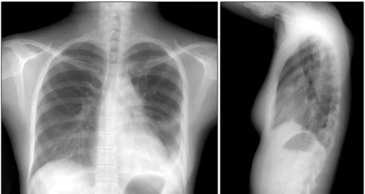 Figure 3. 8 months after anti-TB medication. Chest PA and lateral radiography shows newly developed pleural effusion at  left  hemithorax.