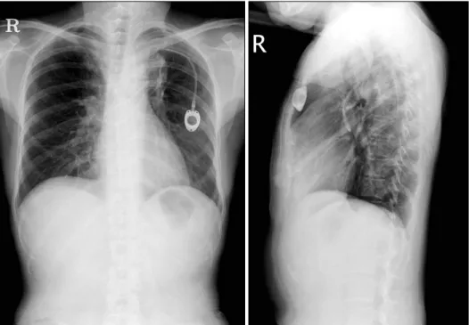 Figure 3. In a cross section, the configuration of the embolized portion  of the catheter is not circular, but instead elliptical.