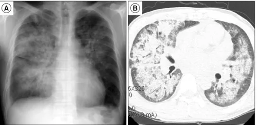 Figure 2. Long-axis parasternal view of two-dimensional echocardiogram during early systole demonstrates mitral regur- regur-gitant  jet  flow  toward  the  left  atrial  appendage  and  mitral  valve  prolapse.