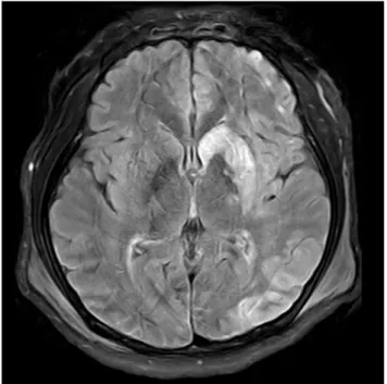 Fig. 4. Brain magnetic resonance imaging scan on postoperative day  4, which showed high-signal intensity along the left  frontotemporopa-rietal including occipital cortex and left caudate nucleus including left  basal ganglia whose impression is a recent 