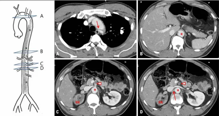 Fig. 1. Illustration and axial contrast-enhanced computed tomography scan of the thoracoabdomen showing type B aortic dissection