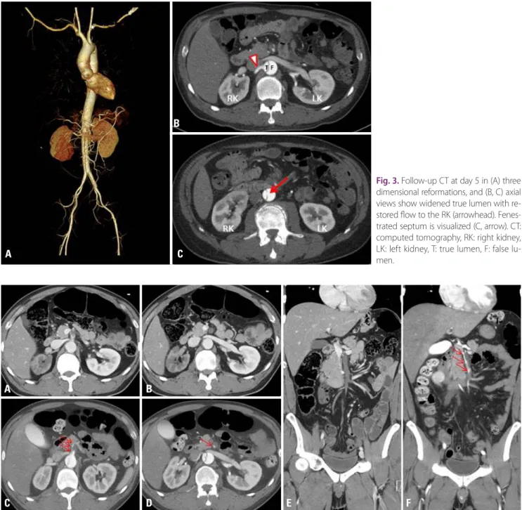 Fig. 3. Follow-up CT at day 5 in (A) three  dimensional reformations, and (B, C) axial  views show widened true lumen with  re-stored flow to the RK (arrowhead)