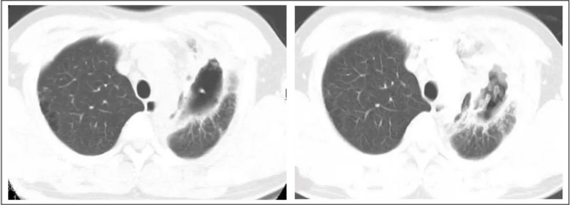 Figure 2.  Resected lung tissue shows 5 cm sized cavity filled with necrotic materials accompanied with dense  peripheral fibrosis