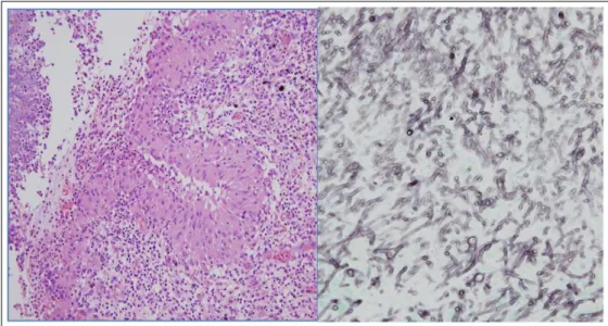 Figure  3.   Microscopic  view  of  resected  lung  tissue.  Fungal  hyphae  are  seen  in  the  left  upper  area,  H&amp;E  stain(x200), left