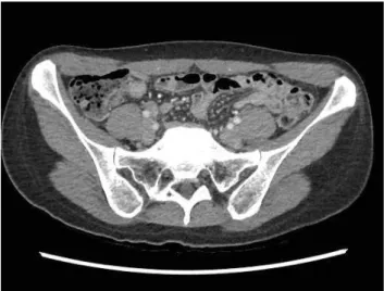 Fig. 4. Rectus sheath hematoma was completely absorbed 3 months  later.