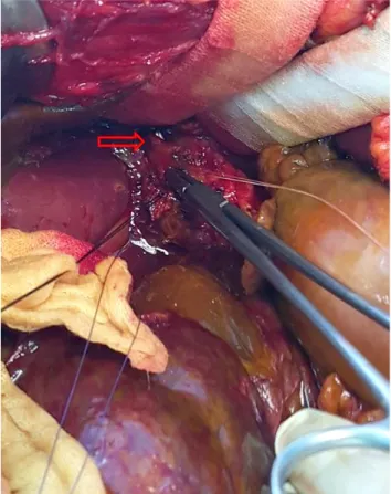 Fig. 1. Abdominal computed tomography showed an increased  amount of fluid collection and edematous thickening of the gallbladder  wall.