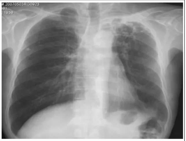 Figure 2.  Initial chest PA shows cicatricial atelectasis  and multiple cavities on left upper lung.
