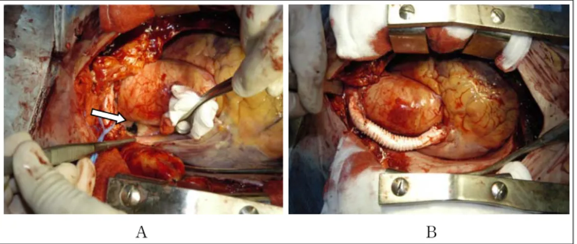 Figure 4.  Focal dense fibrous tissue compressed SVC at the junction of right innominate vein (4A, arrow)