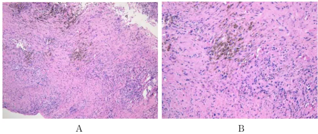 Figure  5.   Dense  collagenized  fibrosis  containing  several  chronic  inflammatory  cells  and  dark  anthracotic  pigmentation
