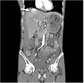 Fig. 3. Computed tomography revealed slight decrease in the size of  the hepatic hemangioma after three months (arrow).