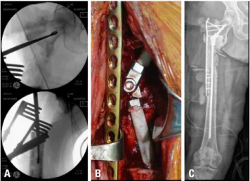 Fig. 3. Conversion to definite fixation. We changed the previous plate  for a new one in view of the infection.