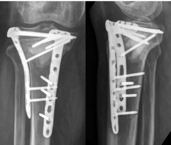 Fig. 6. After bilateral plating, bone graft substitute was placed in the  defect.  