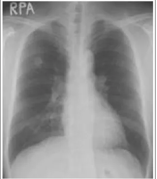 Figure 2.  CT-guided percutaneous biopsy. CT-guided biopsy was done in apical segment of right upper lobe with  prone position (A, B).