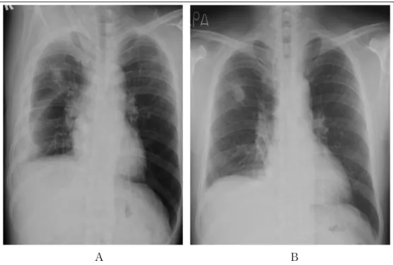 Figure 4.  Chest CT (2 weeks after biopsy). CT showes linear consolidation and pleural effusion along previous  biopsy tract (A-D).