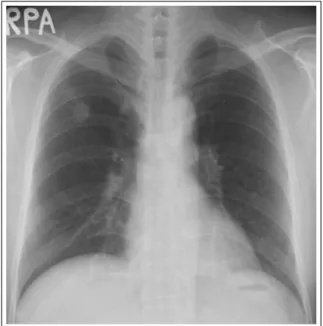 Figure 5.  Chest PA (4 months later). Chest PA shows  disappeared  pleural  effusion  after  anti-Tbc   medi-cation.