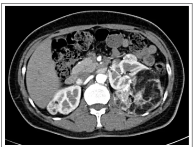 Figure  1.   Chest  X-ray  shows  a  lung  mass  in  right  lower lung field and pneumothorax in left lung.